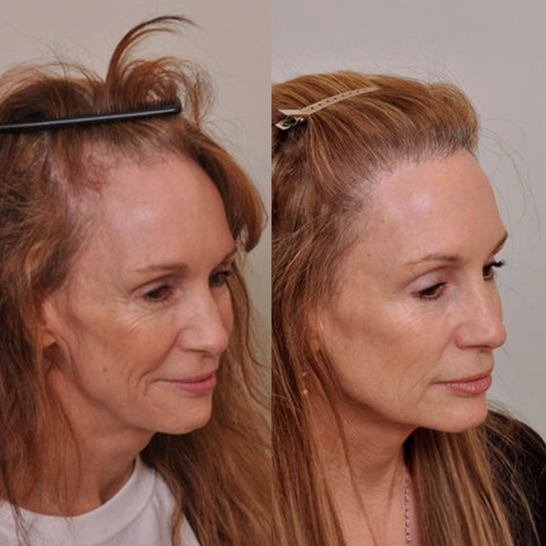 Hair Transplant – The Complete Guide to Natural Hair Restoration
