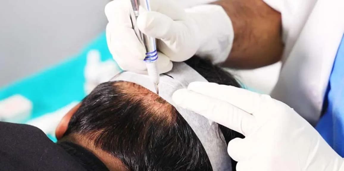 Hair Transplant Turkey: Experience World-Class Medical Tourism