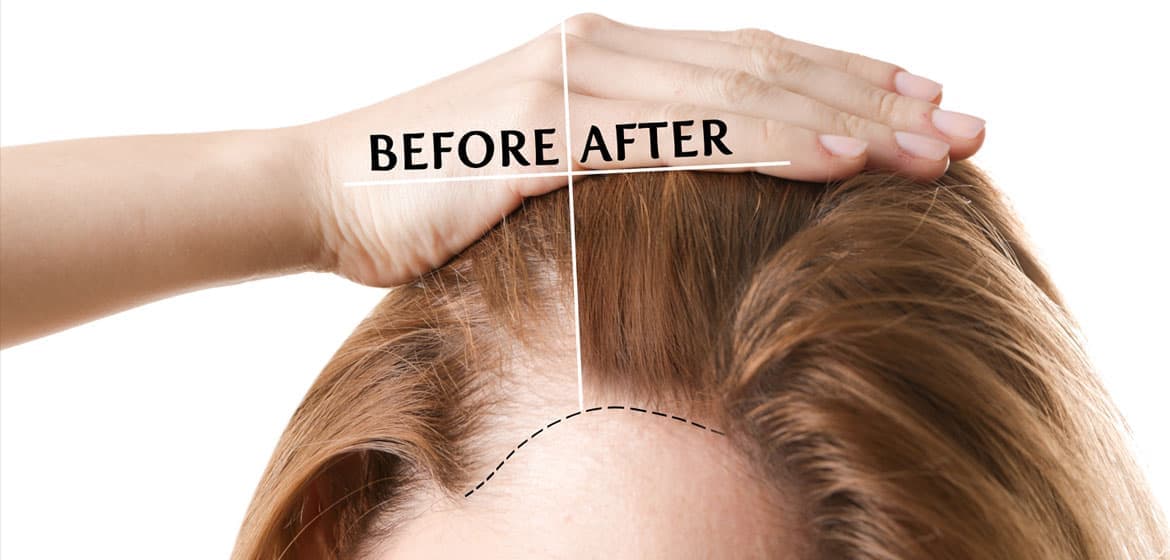 Hair Transplant Istanbul – Affordable and Professional Services
