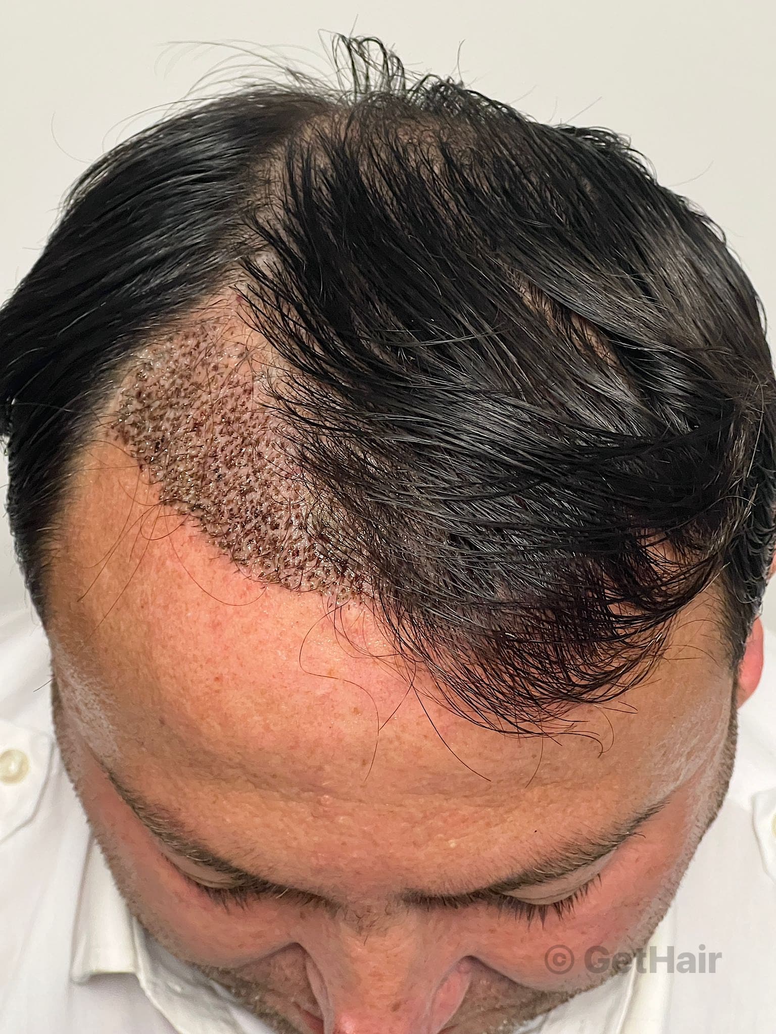 The Complete Guide to Hair Transplant UK Options