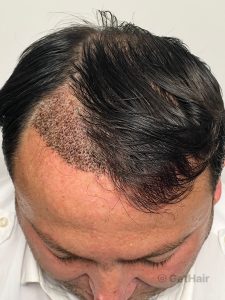 no-shave-hair-transplant